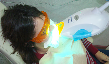 Blanqueamiento Dental