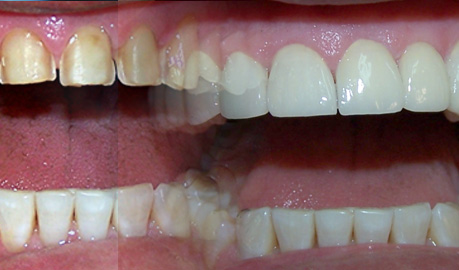 Rehabilitacion Dental
