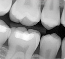 Radiografia Dental