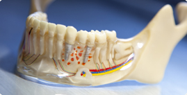 Implantes Dentales