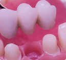 Corona Dental