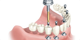 Rehabilitacion Dental