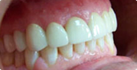 Porcelana Veneer