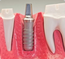Implantes Dentales