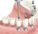 Rehabilitacion Dental