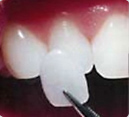 Lamina Veneers