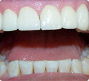 Porcelana Veneer